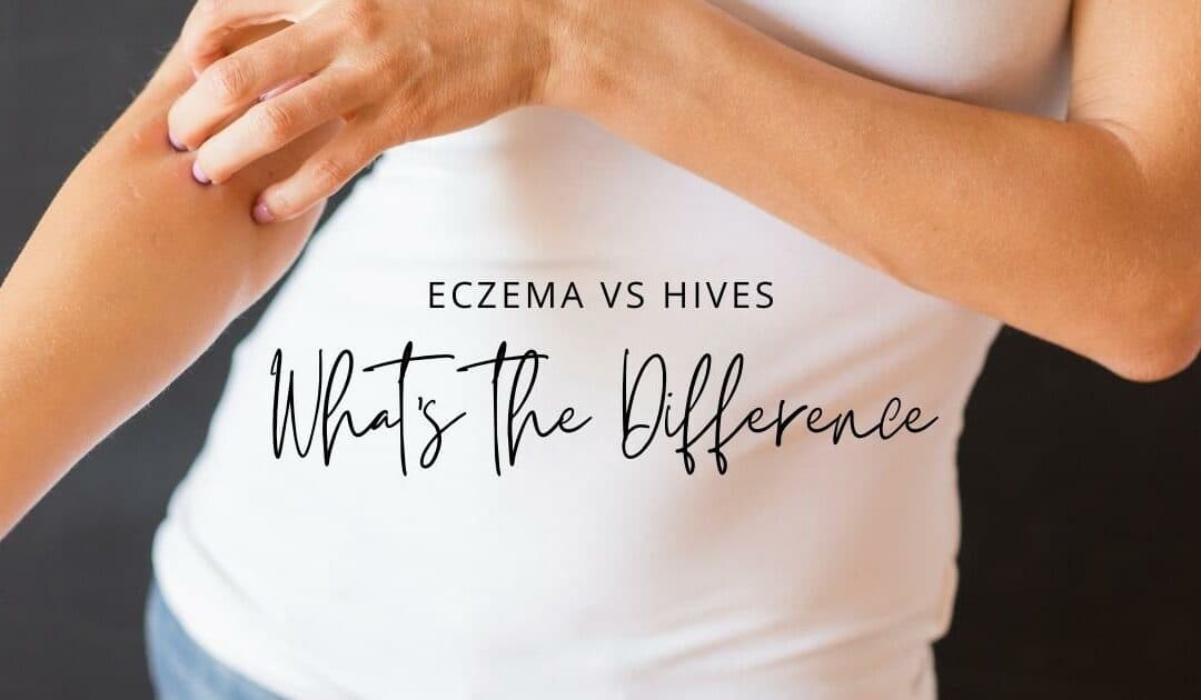 eczema vs hives