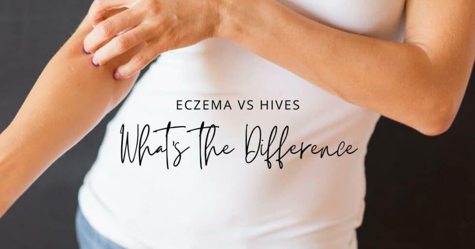 Eczema Vs Hives Whats The Difference Enticare Ent Doctors Arizona 5756