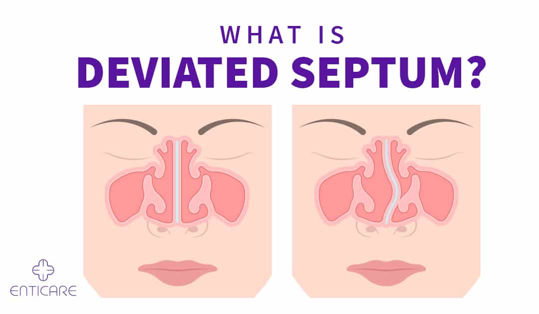 What is Deviated Septum?