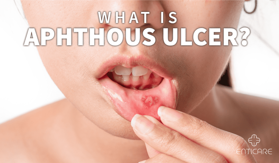 What Is Aphthous Ulcer Enticare Ear Nose And Throat Doctors