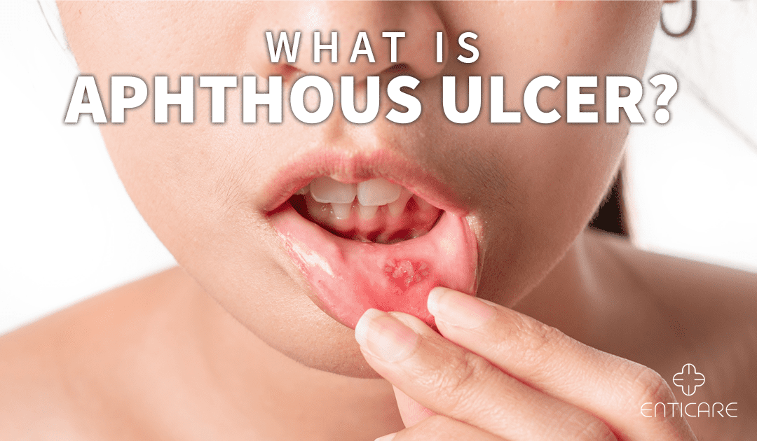 What is Aphthous Ulcer?