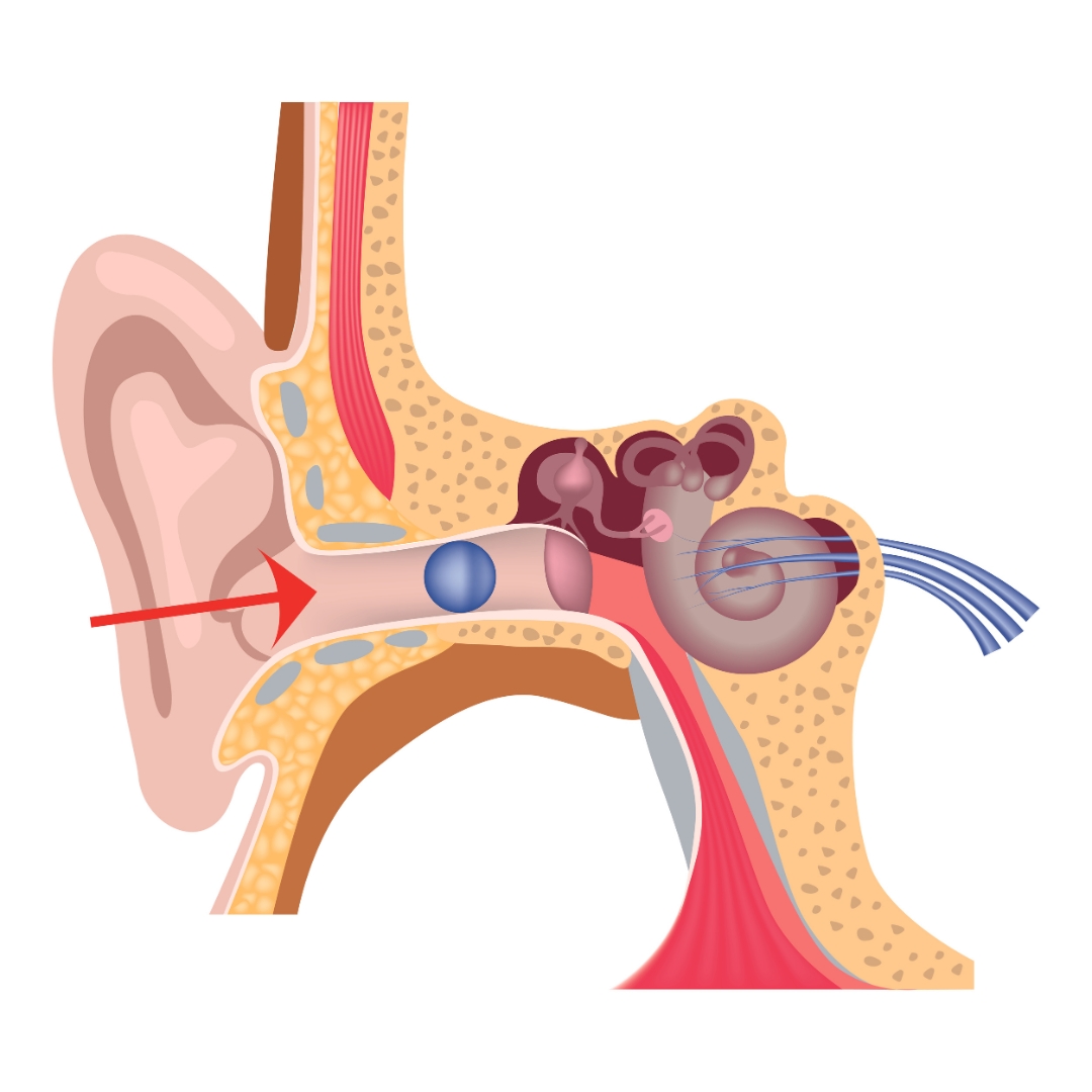 Image of an ear with a foreign body inside