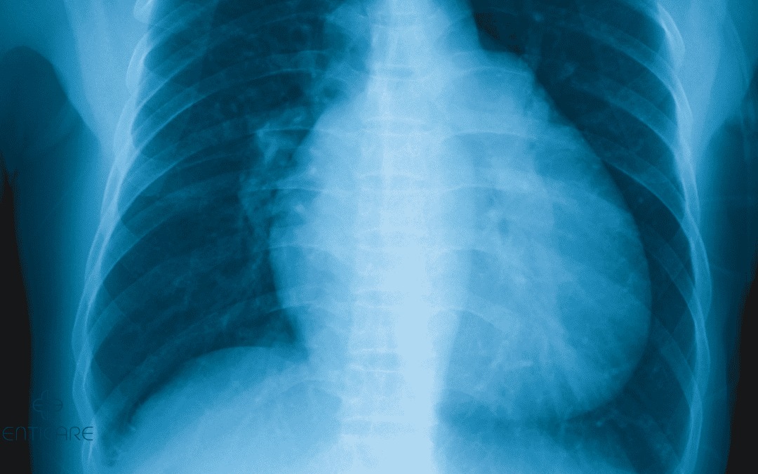 enticare-chest-xray