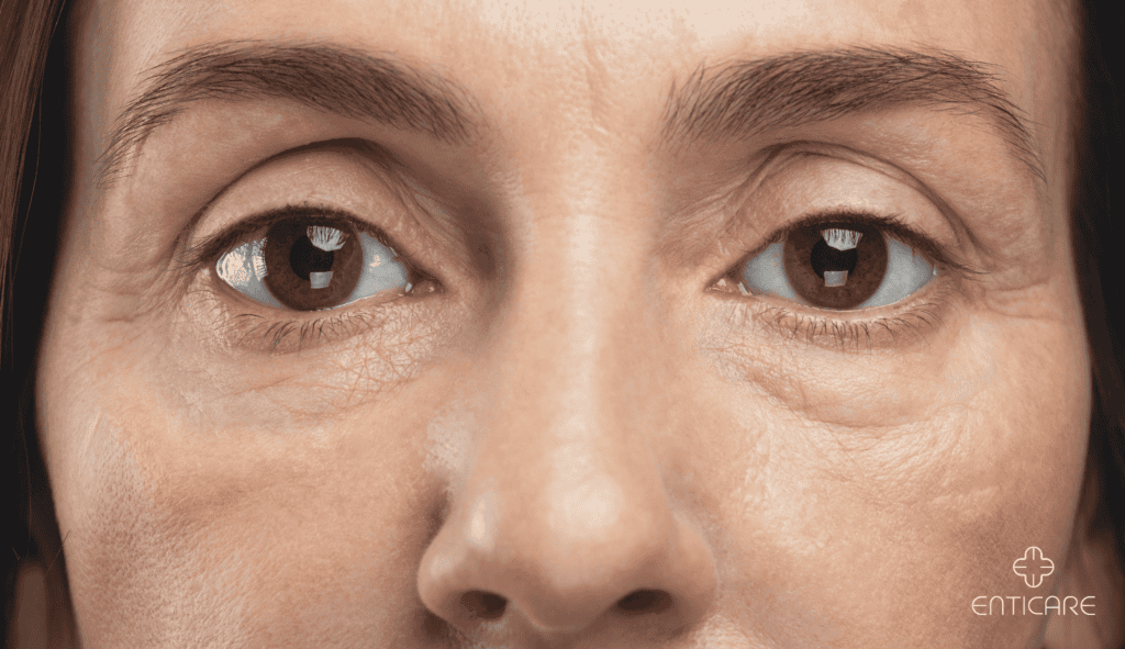 enticare-tired-eyes-woman