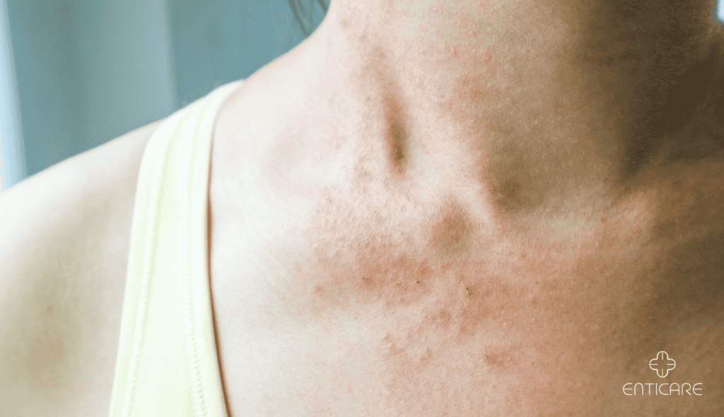 enticare-rash-itch-skin