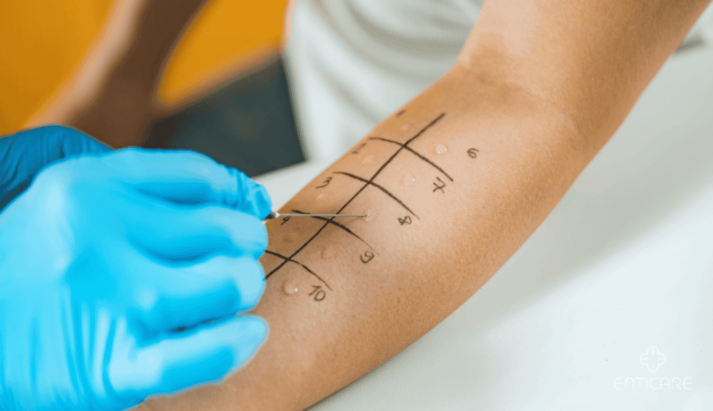 enticare-skin-prick-test