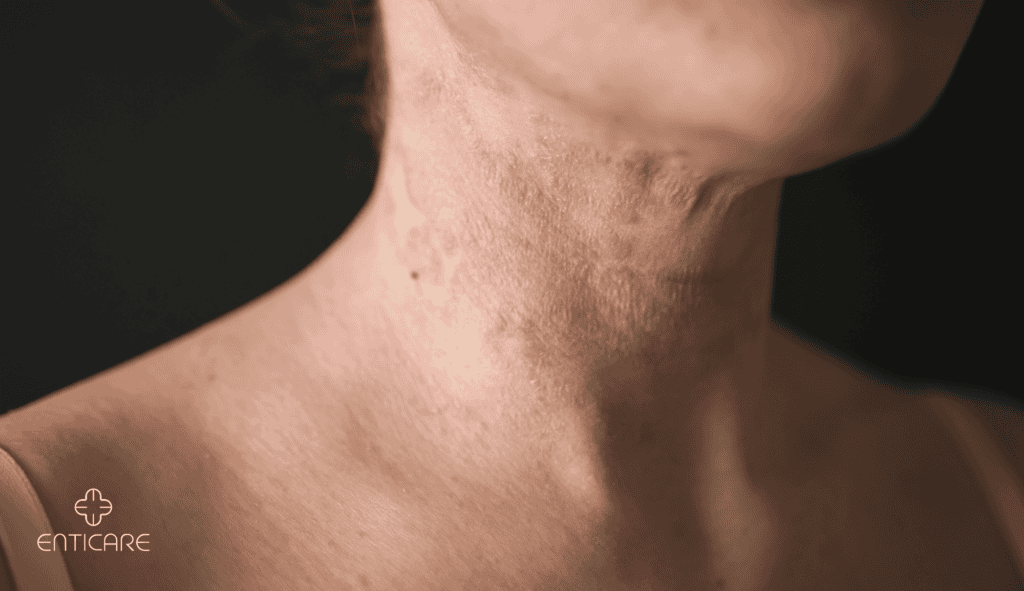 enticare-dermatitis-on-neck