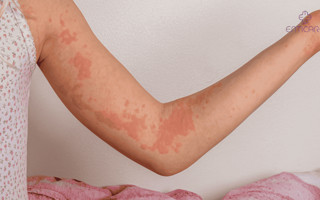 enticare-girl-with-urticaria