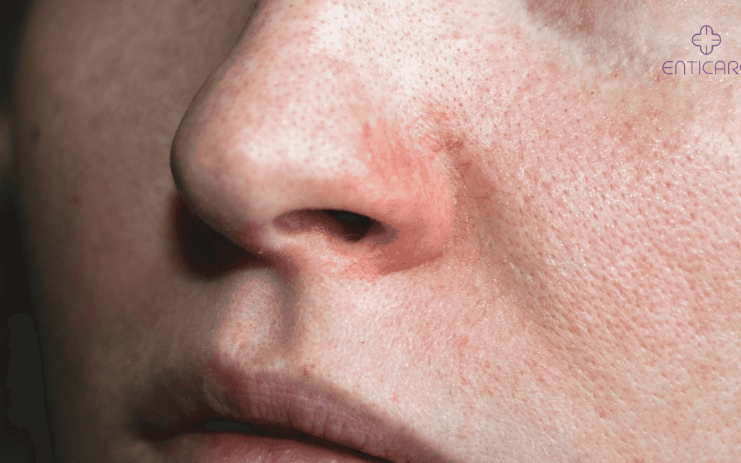 enticare-nose-rash