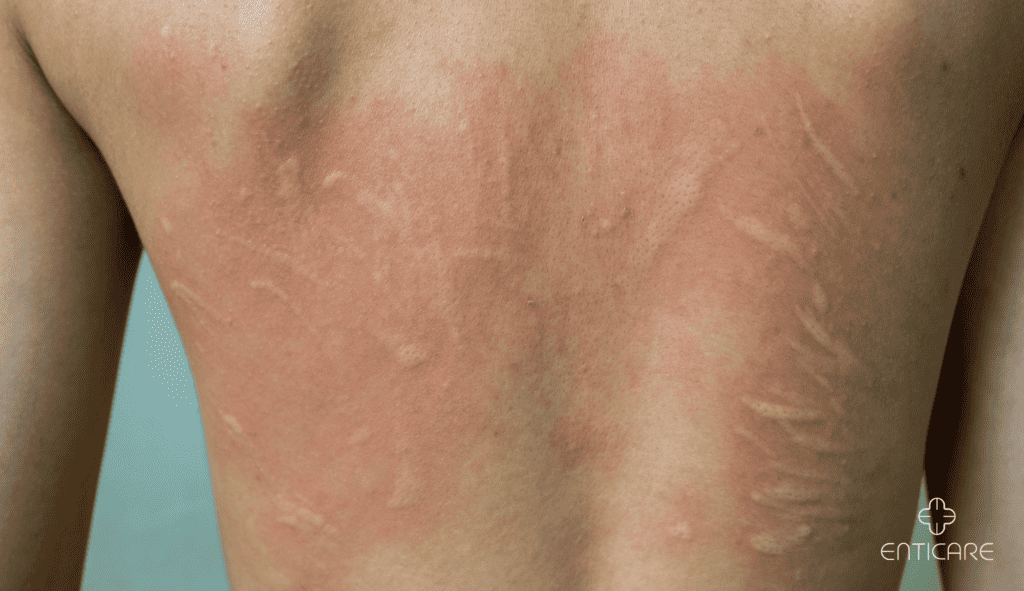 enticare-urticaria-back