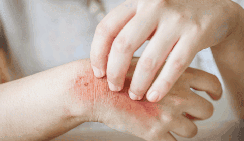Understanding Skin Rash from Mice: Causes and Prevention Tips